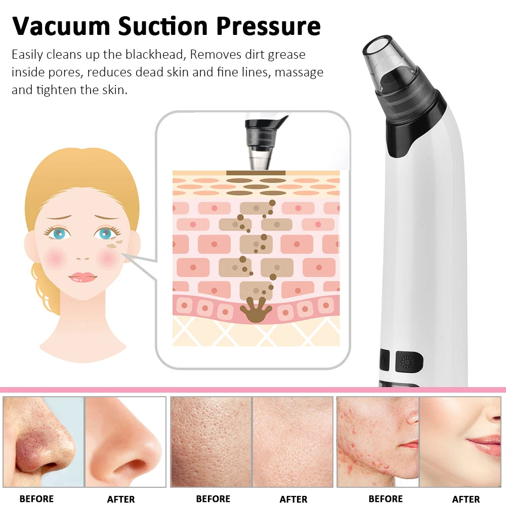 Electric Blackhead Remover