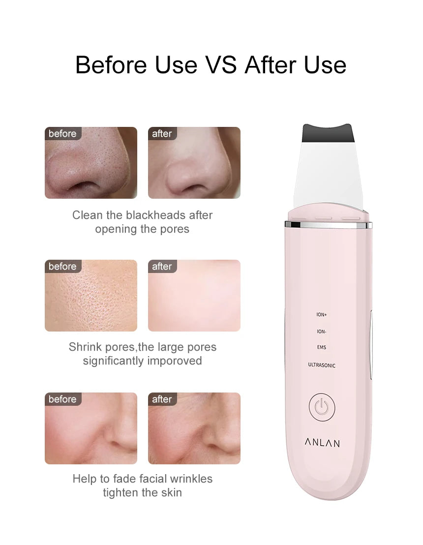 ANLAN Ultrasonic Skin Scrubber