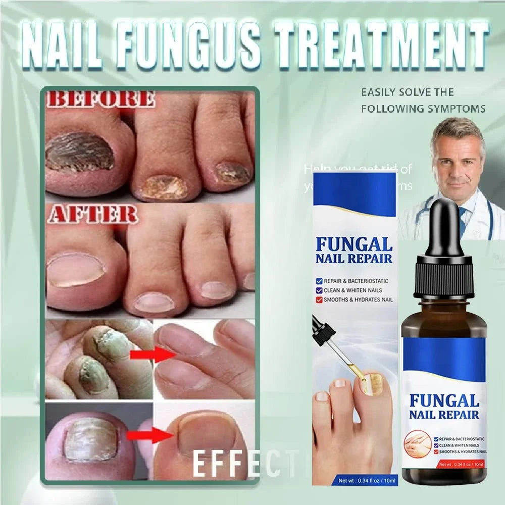 Fungal Nail Treatment Essence & Laser Device